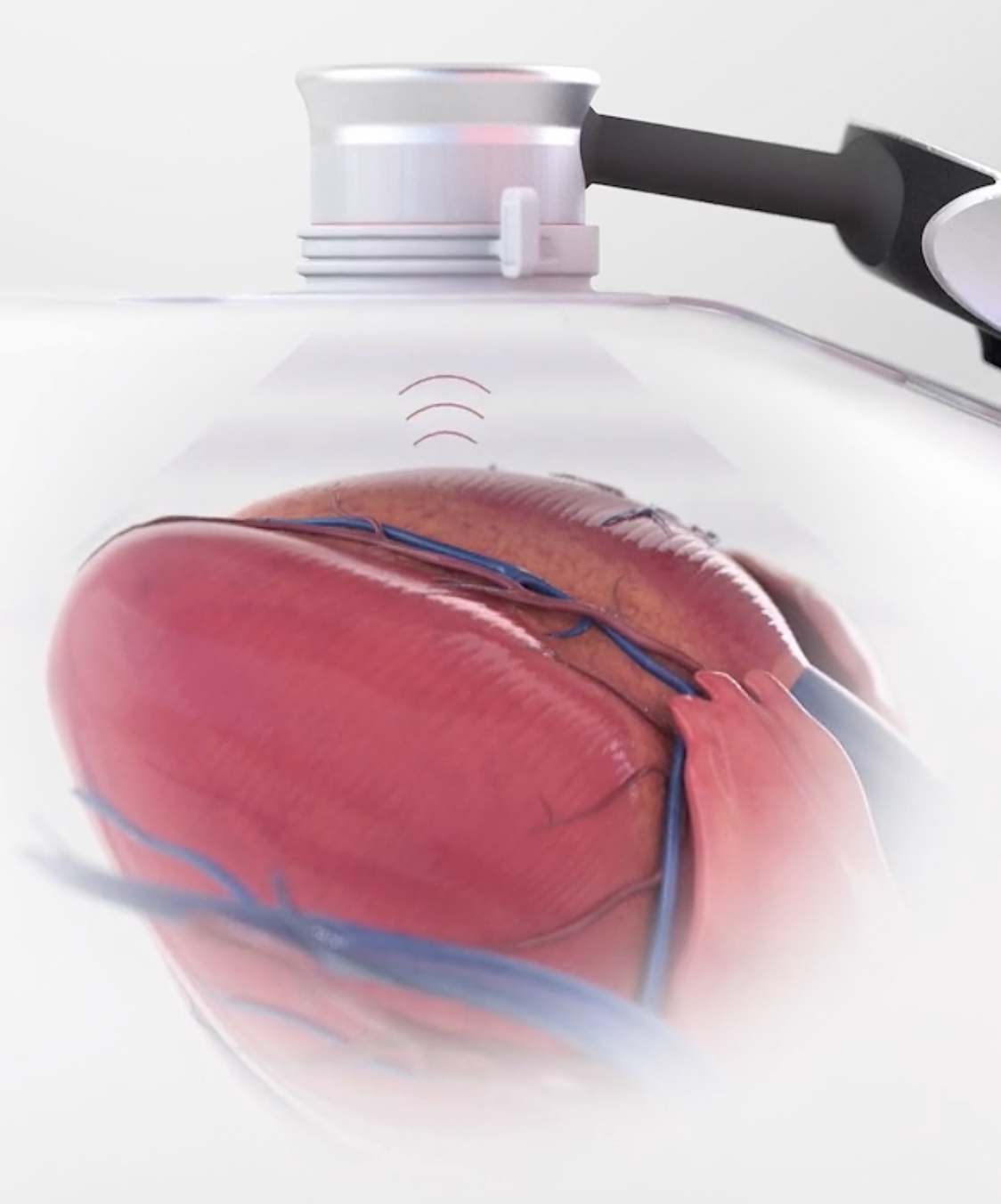 CADScor heart sound assessment showing acoustic sensor analyzing coronary artery disease risk